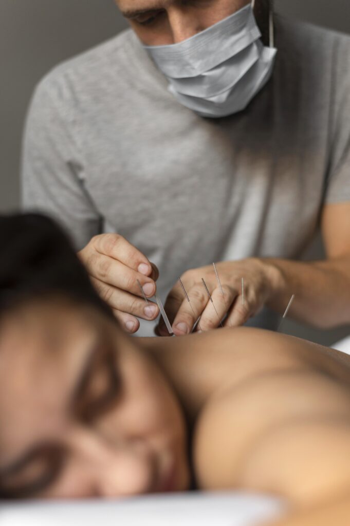close up therapist doing acupuncture